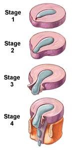 slipped disc treatment